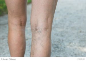 Spider veins vs Varicose Veins