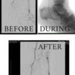 Before, during and after of PAD treatment