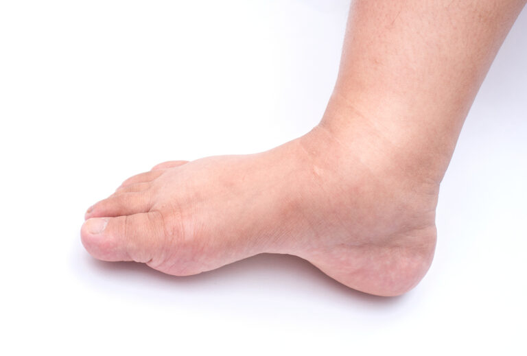 edema and lymphedema in leg