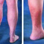Changes in skin color, when feet turn darker, is a warning for vein disease
