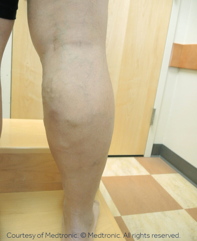 why is my vein swollen