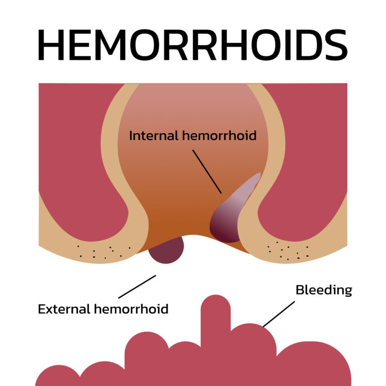 Diagram of internal hemorrhoids