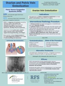 facts on PVCS and Ovarian Embolization
