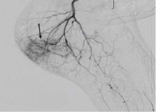 Plantar Fascitis before