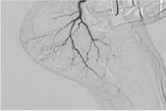 Plantar Fascitis after
