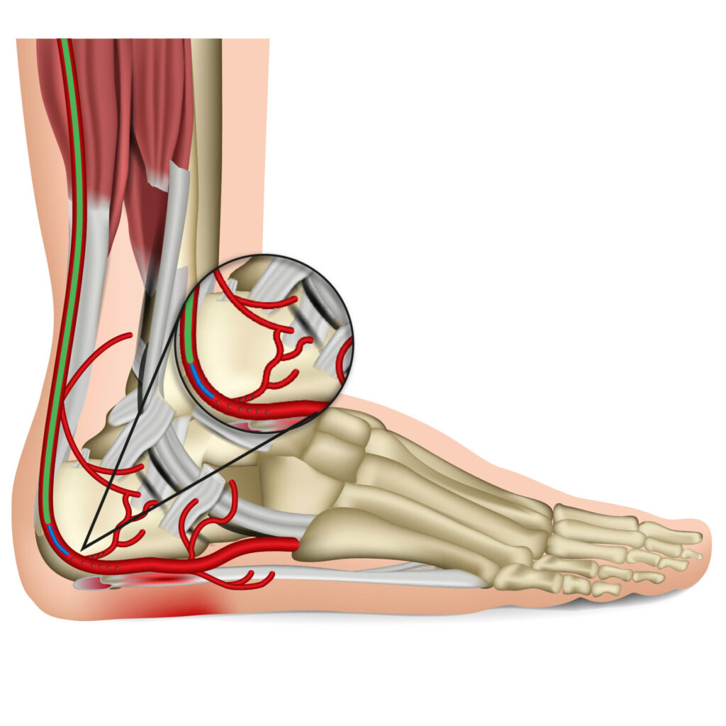 Plantar Fascitis model