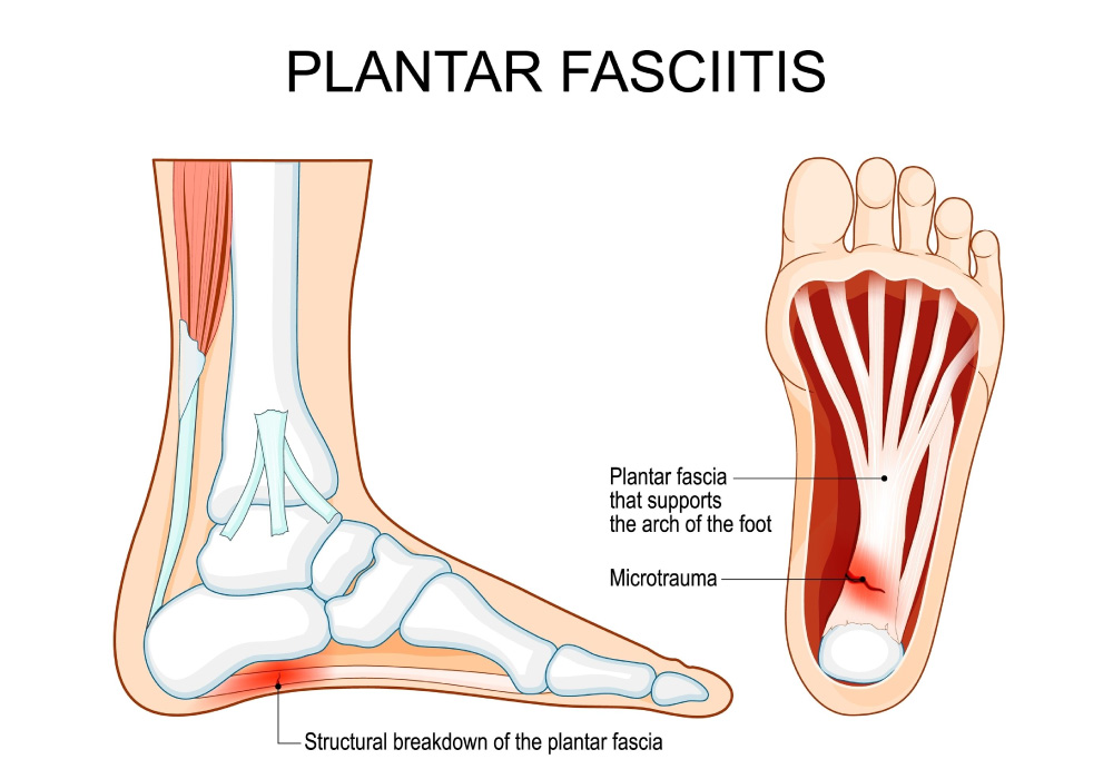 Plantar Fascitis model