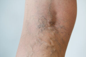 varicose veins on leg