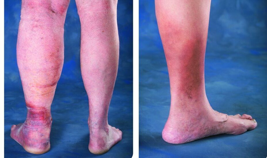 Changes in skin color, when feet turn darker, is a warning for vein disease
