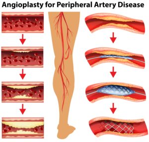 angioplasty for PAD