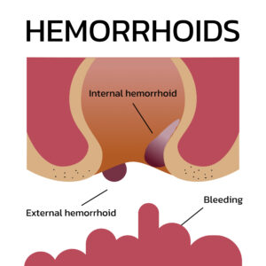 Diagram of internal hemorrhoids 